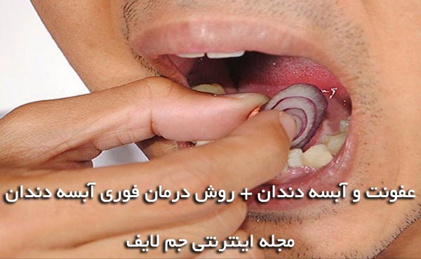 آبسه دندان , درمان فوری آبسه دندان