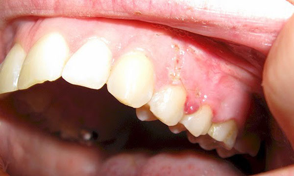 کیست لثه, کیست دندان, علت کیست لثه, درمان کیست لثه, کیست دندان نوزاد