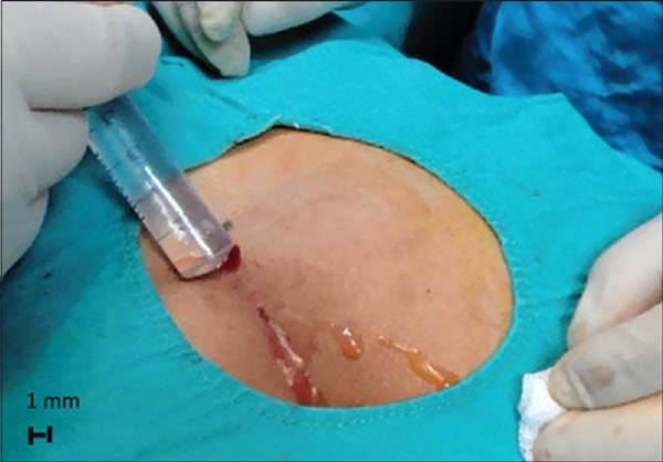 تزریق فنول در جراحی کیست مویی یا سینوس پیلونیدال 